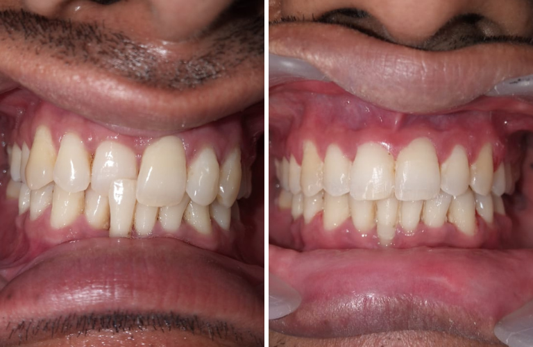 Braces Treatment In Kalyan