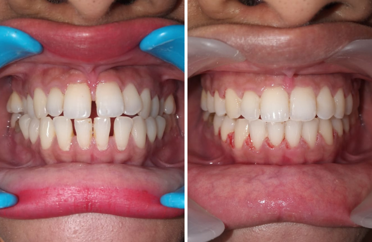 Braces Treatment In Kalyan