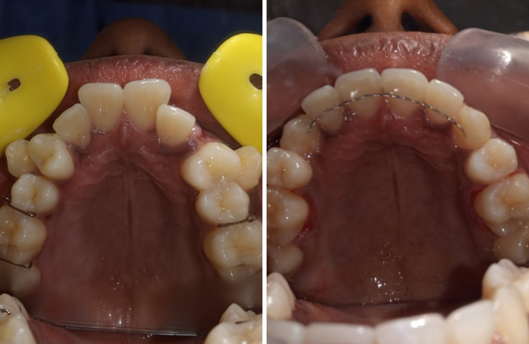 Braces Treatment In Kalyan