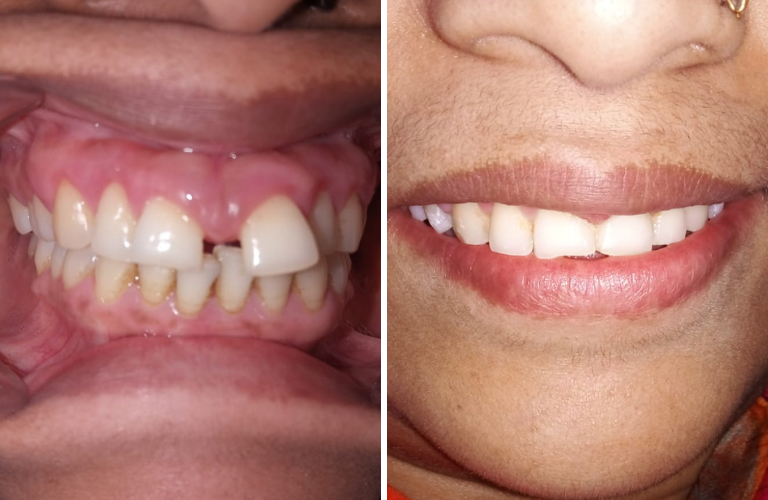 Braces Treatment In Kalyan