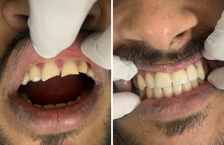 Teeth Filling / Dental Filling in Kalyan at Risus Multi Speciality Dental Clinic