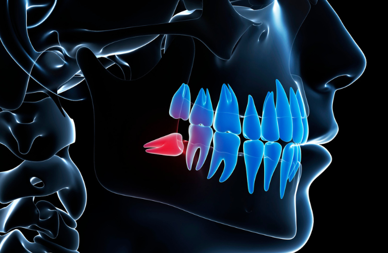 Wisdom Tooth Extraction In Kalyan
