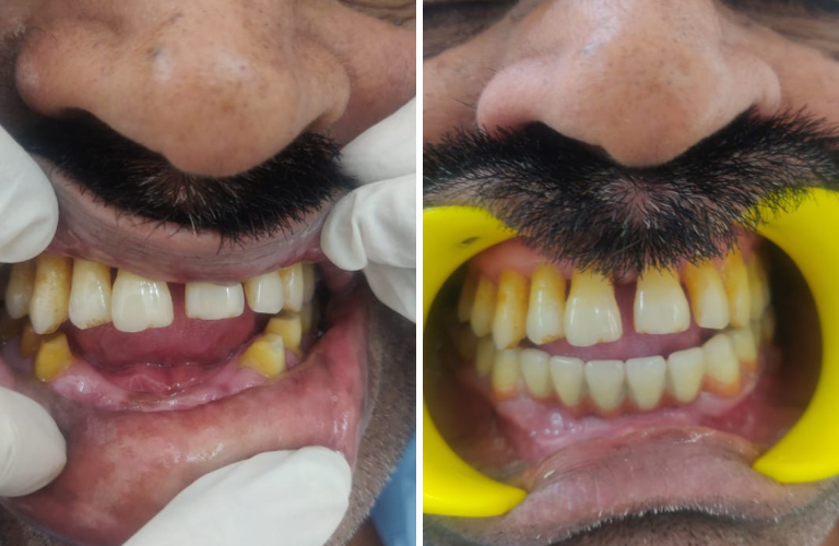 Missing Tooth Solution - Dental Bridge - Risus Multi Specilaity Dental Clinic
