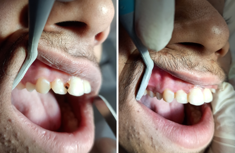 Teeth Filling / Dental Filling in Kalyan at Risus Multi Speciality Dental Clinic