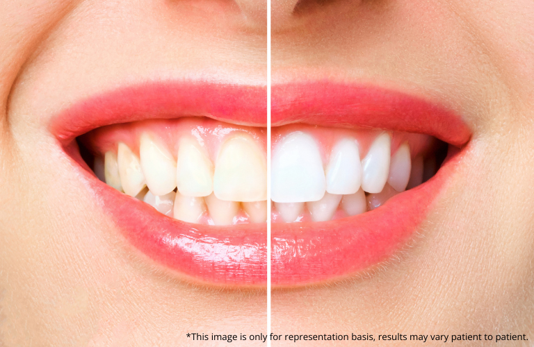 Teeth Whitening In Kalyan