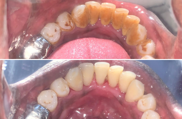Teeth Cleaning In Kalyan