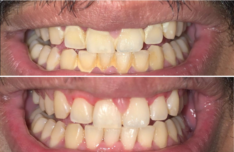 Teeth Cleaning In Kalyan