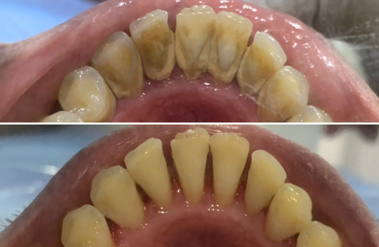 Teeth Cleaning In Kalyan