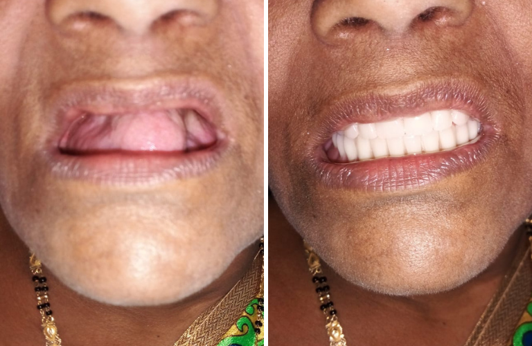 Denture | Risus Multi Speciality Dental Clinic