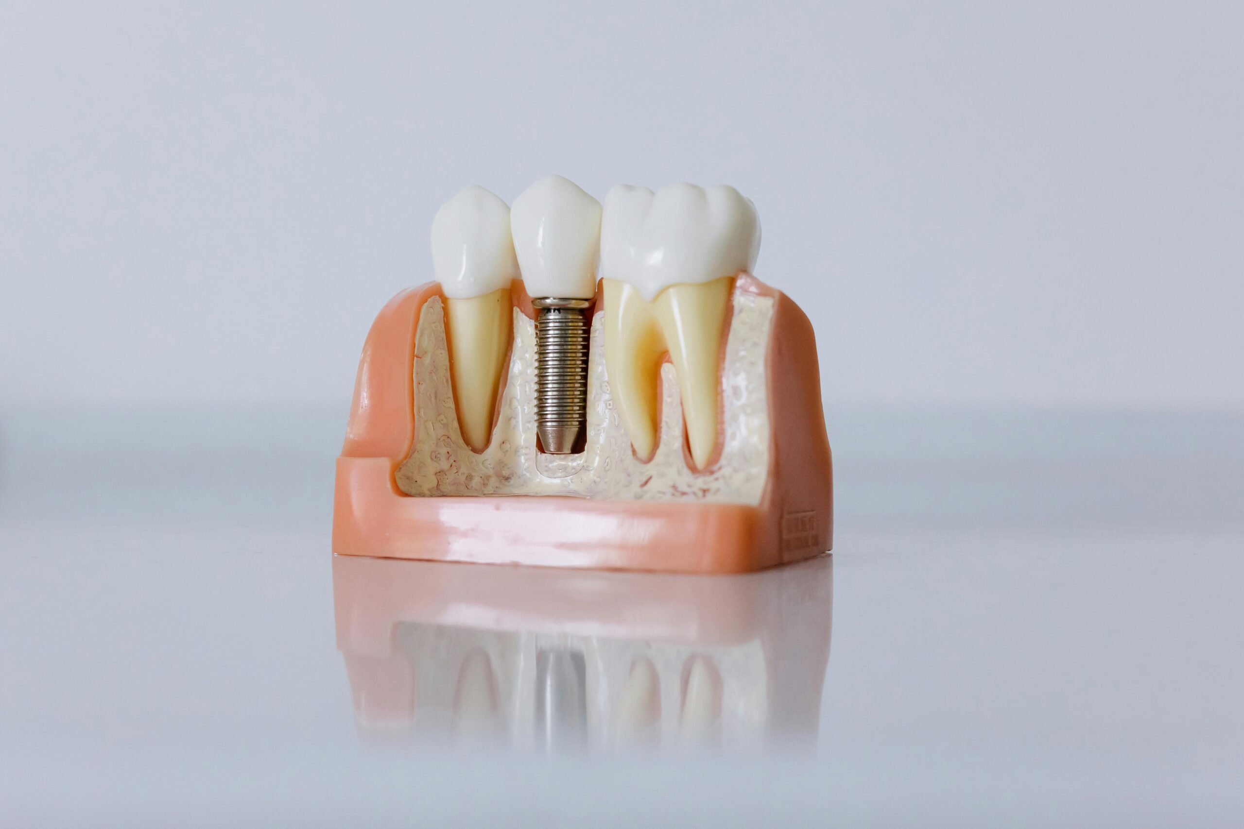 pexels-photo-6502305-6502305 Detailed dental implant model showcasing teeth structure for educational purposes.
